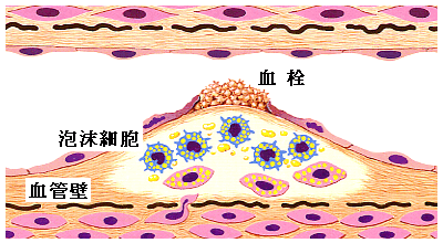 泡沫細胞